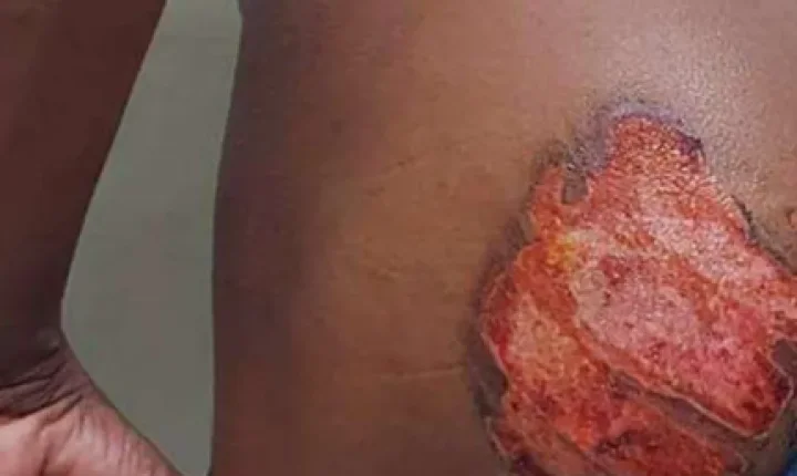 Jovem é brutalmente torturado com ferro em brasa; suspeitos são presos no sudoeste da Bahia